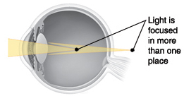 Cross section of eye showing light focusing in more than one place.