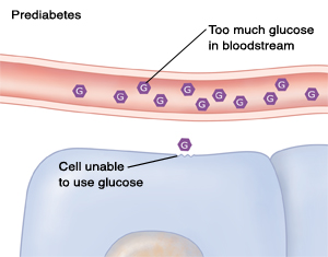 Cross section of blood vessel and cells showing too much glucose in blood because of prediabetes.