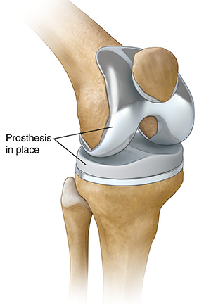 Total knee prosthesis in place.