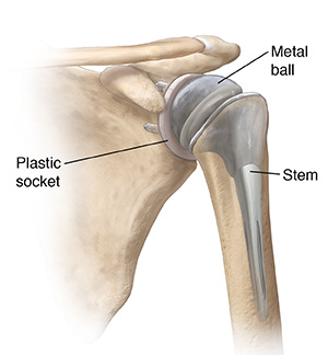 Front view of shoulder joint with total shoulder replacement.