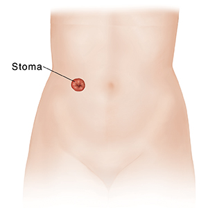 Front view of female torso and pelvis showing urinary stoma.
