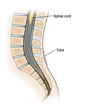 Side view cross section of lower spine showing catheter inserted into spinal canal.