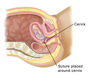 Cross section side view of woman's pelvis showing baby developing in uterus. Line shows where sutures are placed to hold cervix closed.