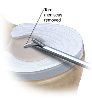 Top view of meniscus showing instrument removing tissue.