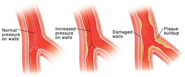 Cross section of artery with arrows showing normal blood pressure on inside walls. Cross section of artery with arrows showing high blood pressure on inside walls. Cross section of artery showing damaged lining and plaque buildup.