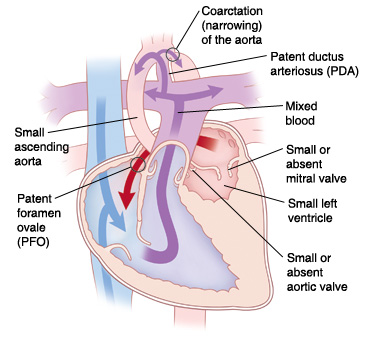 Front view cross section of heart showing hypoplastic left heart syndrome: coarctation (narrowing) of the aorta, patent ductus arteriosus (PDA), small or absent mitral valve, small left ventricle, small or absent aortic valve, patent foramen ovale (PFO), and small ascending aorta. Arrows show blood flowing from left atrium to right atrium through PFO, and mixed blood going from right ventricle to pulmonary artery and into aorta through PDA.