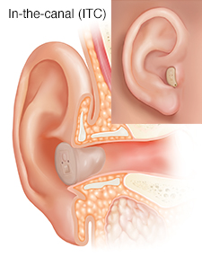 Cross section of ear showing outer, inner, and middle ear structures with in-the-canal hearing aid in place.