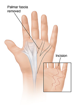 Palm view of hand showing palmar fascia removed with an inset showing a zigzag incision. 