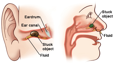 Front view of ear showing object stuck in ear canal and eardrum with fluid buildup. Side view of child's face showing stuck object in nose with fluid buildup.