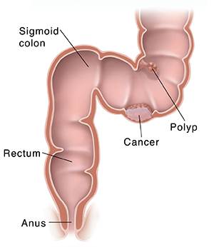 Cross section of sigmoid colon, rectum, and anus showing cancer and polyp.