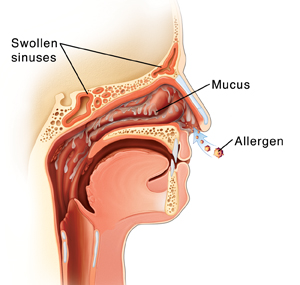 Cross section side view of head showing allergens entering nose, swollen nasal lining, and fluid dripping from nasal lining.