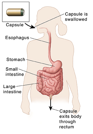 Outline of body showing gastrointestinal tract and path of capsule for capsule endoscopy.