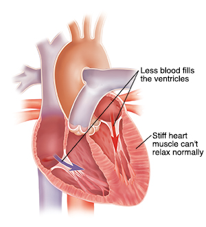 Cross section of heart with diastolic heart failure.
