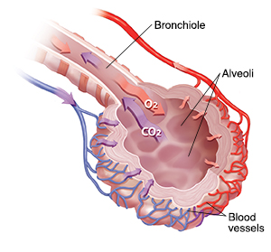 Closeup view of bronchiole and alveolus showing thickened interstitial tissue.