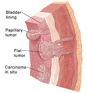 Cross section through bladder wall showing lining, submocosa, muscle, fat, and three types of cancer: papillary tumors, sessile tumors, and carcinoma in situ.