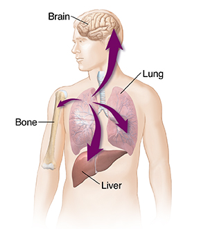Outline of male figure with arrows showing lung cancer spreading to liver, other lung, bone, and brain.