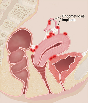 Side view cross section of woman's pelvis showing inflamed areas of endometriosis.