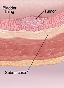 Cross section of bladder wall showing cancer at superficial stage.