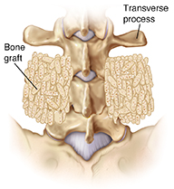 Back view of lumbar vertebrae showing bone graft between transverse processes.