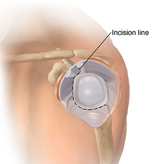 Side view of shoulder joint showing an incision line releasing a frozen shoulder.