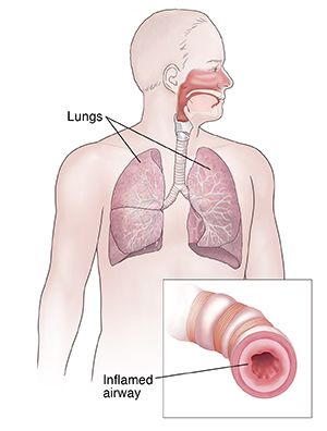 Front view of man showing respiratory system. Inset shows inflamed airway.