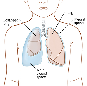 Outline of child showing lungs in chest. Left lung is normal and surrounded by thin pleural space. Right lung is collapsed and air is filling pleural space.