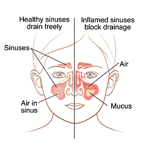 Front view of child’s face showing normal sinus anatomy on one side and inflamed sinuses on the other.