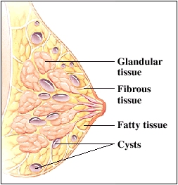 Side view of cross section of breast showing glandular tissue, fibrous tissue, and fatty tissue. Multiple cysts throughout breast tissue.