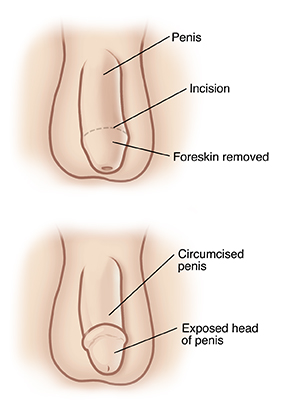Front view of penis and scrotum. Line around head of penis shows circumcision incision. Foreskin at tip of penis is removed.