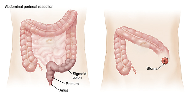 Outline of adult abdomen showing large and small intestines. Shaded area on sigmoid colon, rectum, and anus shows abdominal perineal resection. Outline of abdomen showing stoma after abdominal perineal resection.