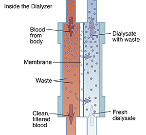 Diagram showing how blood moves through dialyzer to filter out waste.
