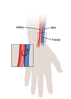 Silhouette of hand and wrist showing fistula for hemodialysis. Inset shows blood flow through fistula.