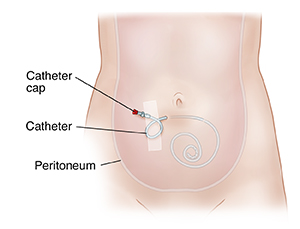 Front view of abdomen showing peritoneal dialysis catheter in place.