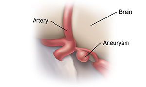 Closeup view of brain aneurysm.