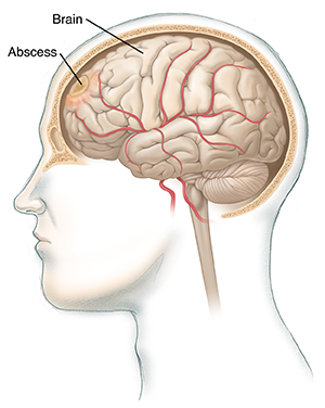 Side view of head with cross section of skull showing whole brain with abscess.