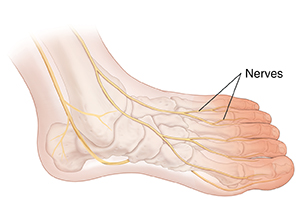 Top view of foot partly to the side showing bones and nerves. Forefoot is shaded in.