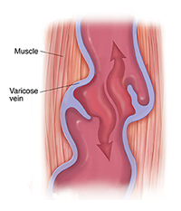 Cross section of muscle and varicose vein with damaged valve. Arrow shows blood moving down.