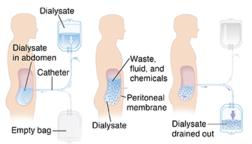 Side view of man showing three steps in peritoneal dialysis.