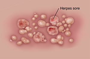 Closeup of genital herpes sores on skin.