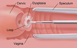 Cross section of vagina and cervix showing loop instrument removing dysplasia from cervix.