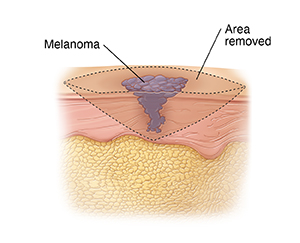 Skin layers with melanoma showing incision lines to remove tumor.