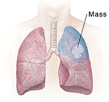 Front view of chest showing lungs. Shaded area shows segment resection.