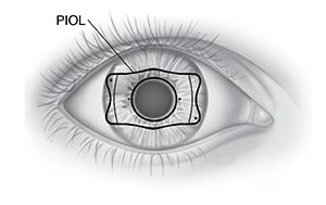 Front view of eye showing position of PIOL behind iris.