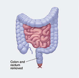 Front view of lower digestive tract with colon and rectum removed, showing ileoanal pouch.