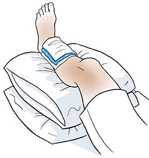 Leg elevated on pillows with ice pack wrapped in thin towel on shin.