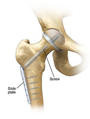 Front view of hip joint showing compression screw repairing femoral fracture.