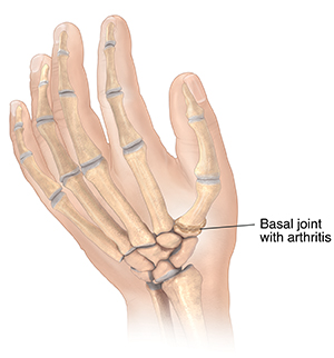 Back view of hand showing arthritis in joint at base of thumb.