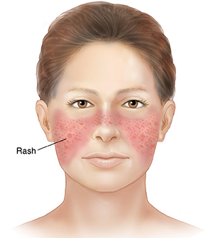Woman’s face with butterfly-shaped rash across cheeks and nose.