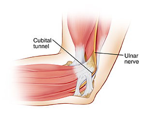 Side view of elbow showing ulnar nerve going through cubital tunnel.