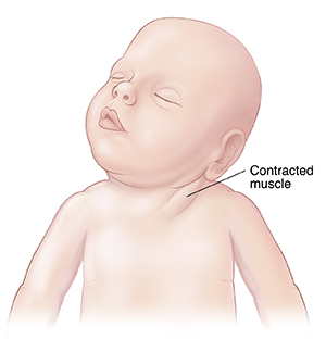 Front view of baby with muscle in neck contracted and head turned to side.